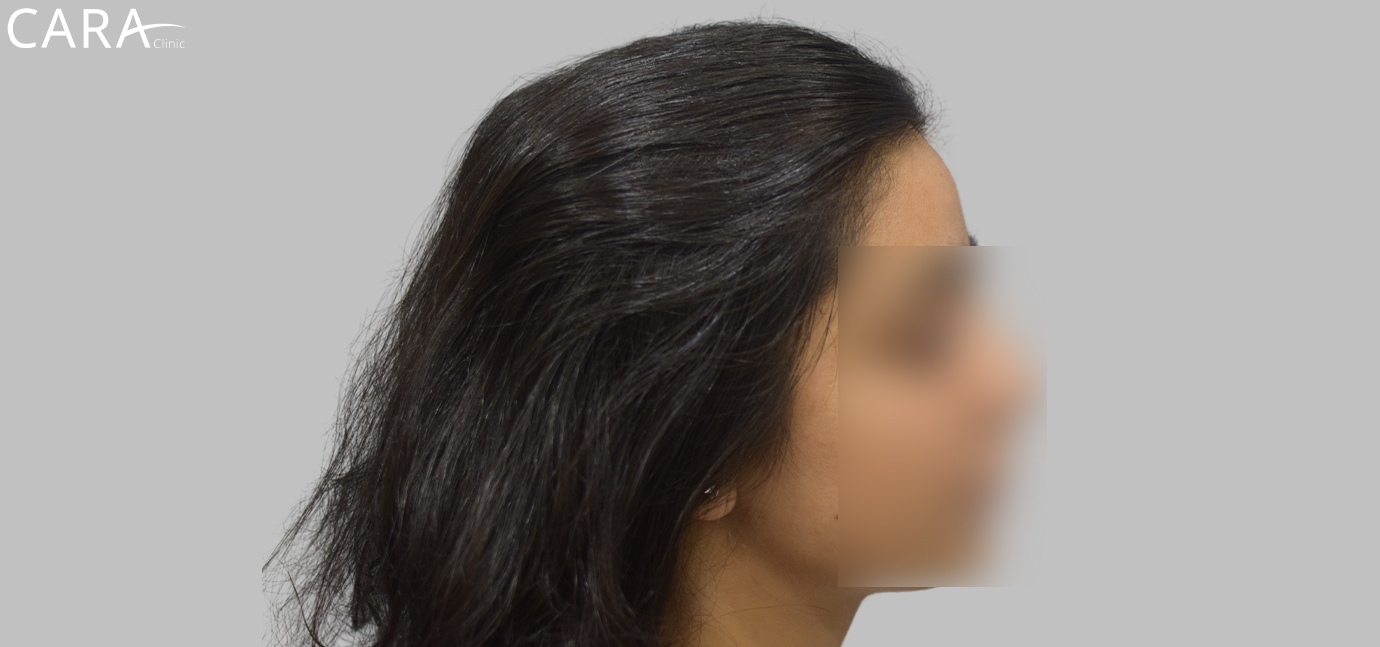 After female hair loss treatment at Cara Clinic highlighting restored hair volume, density, and a fuller appearance.