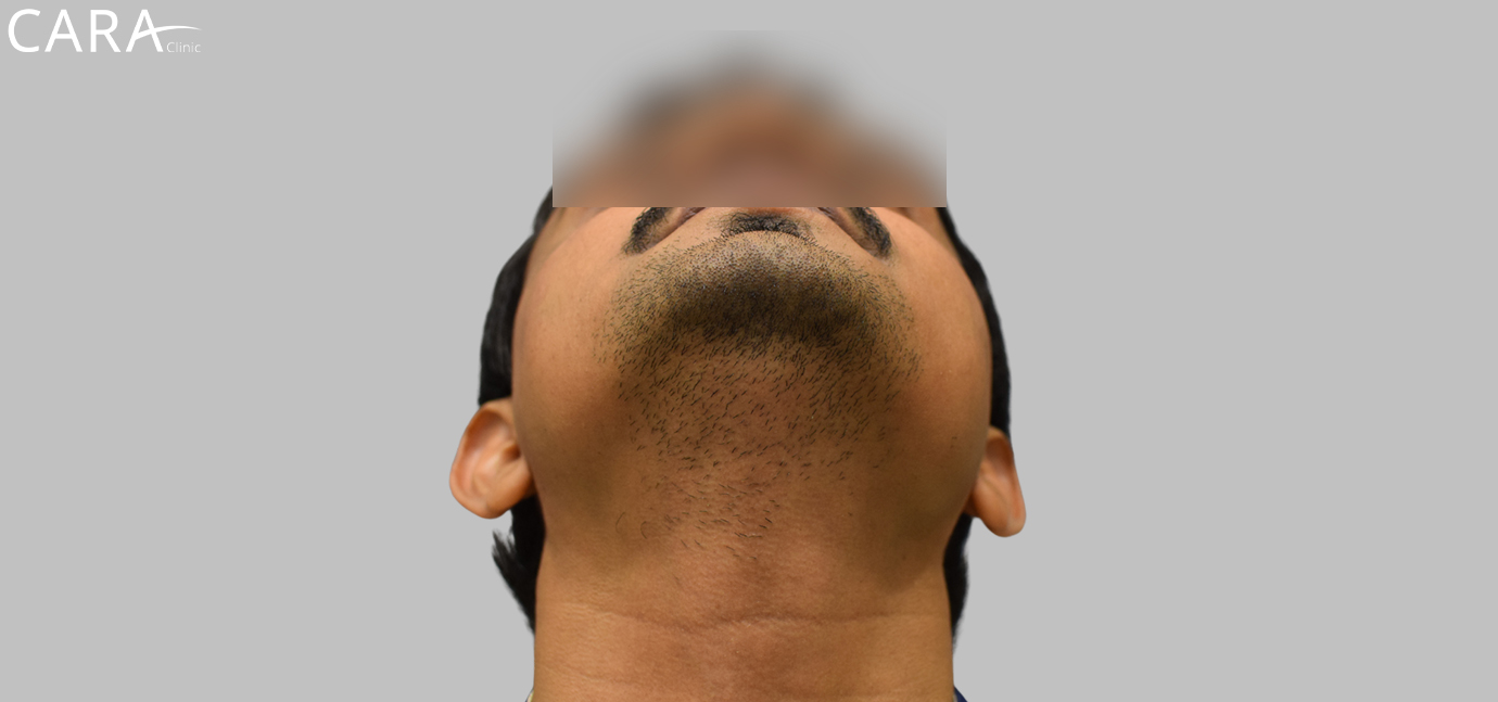 Before image of a beard hair transplant showing patchy and uneven facial hair growth.