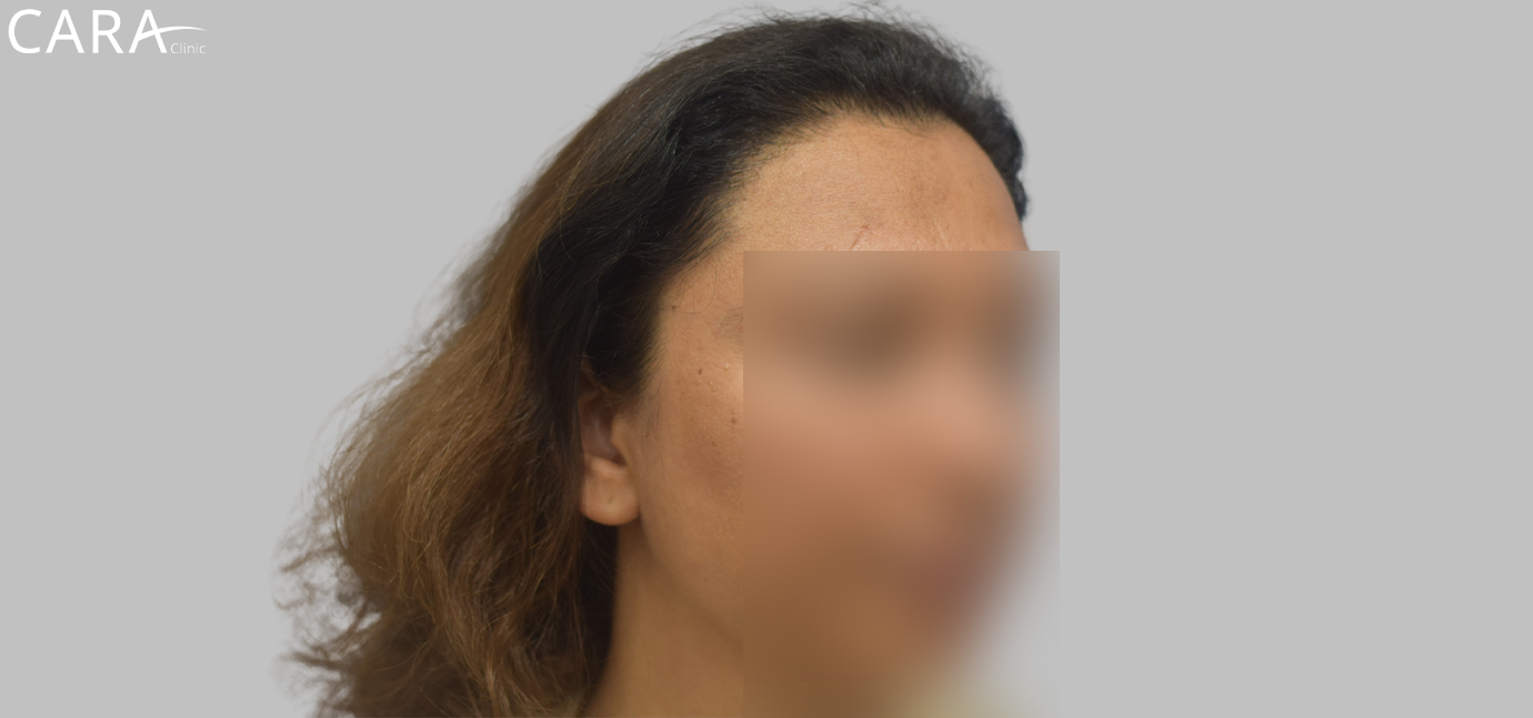 After image of female hair transplant at Cara Clinic highlighting a fuller hairline with natural-looking restored hair density.