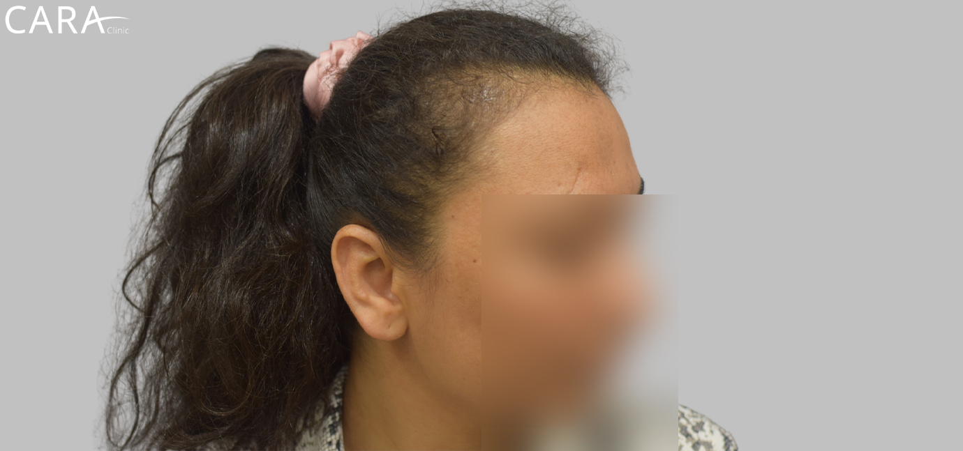 Before and after banner image of a female hair transplant showing significant improvement from thinning hair to a fuller, natural-looking hairline.