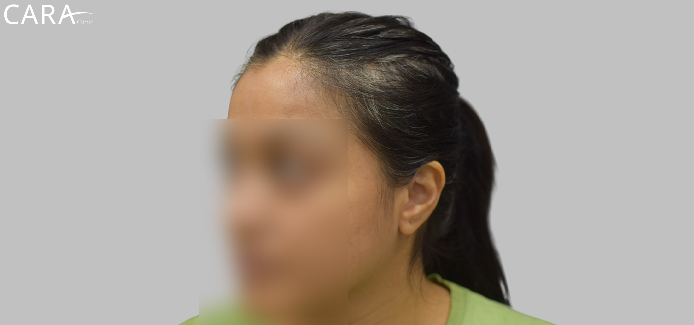 Before female hair loss treatment at Cara Clinic showing visible hair thinning and scalp exposure.