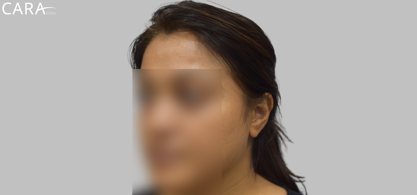 After female hair loss treatment at Cara Clinic highlighting restored hair volume, density, and a fuller appearance.