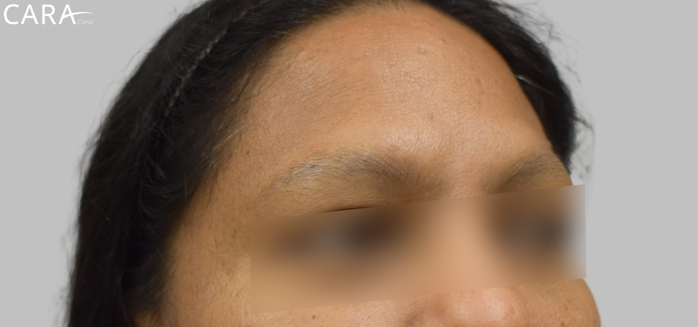 Before image of eyebrow transplant at Cara Clinic showing sparse, uneven eyebrow hair.