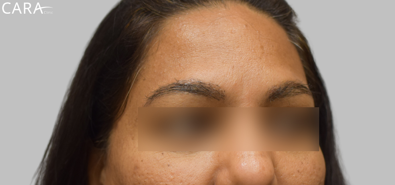 After image of eyebrow transplant at Cara Clinic highlighting fuller, symmetrical, and natural-looking eyebrows.