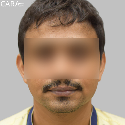 before image of a beard hair transplant showing a fuller, even, and natural-looking beard.