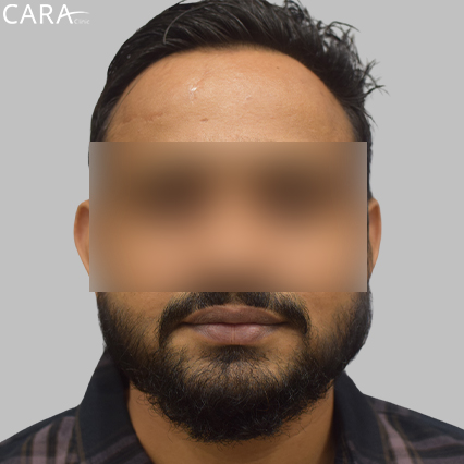 After image of a beard hair transplant showing a fuller, even, and natural-looking beard.