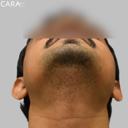 before image of a beard hair transplant showing a fuller, even, and natural-looking beard.