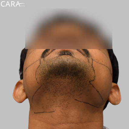 marking image of a beard hair transplant showing a fuller, even, and natural-looking beard.