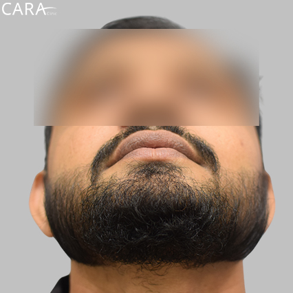 After image of a beard hair transplant showing a fuller, even, and natural-looking beard.