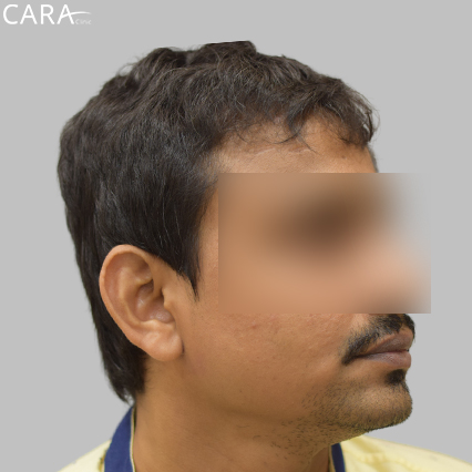 before image of a beard hair transplant showing a fuller, even, and natural-looking beard.