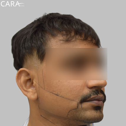 marking image of a beard hair transplant showing a fuller, even, and natural-looking beard.