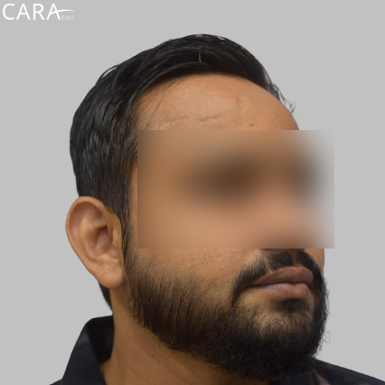 After image of a beard hair transplant showing a fuller, even, and natural-looking beard.