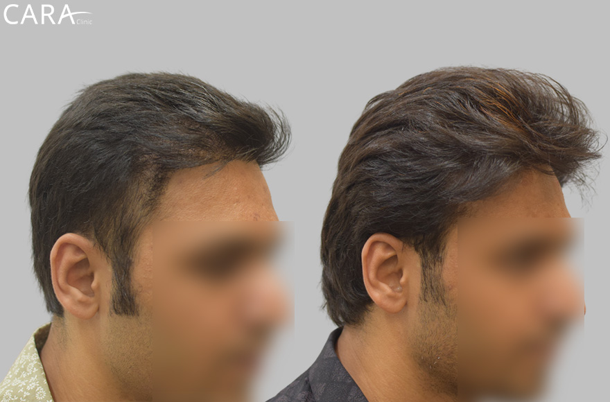 repair hair transplant image himesh