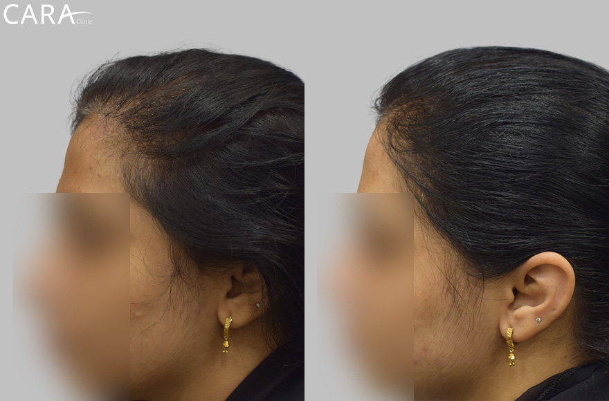 before and after image of female hairloss treatment image