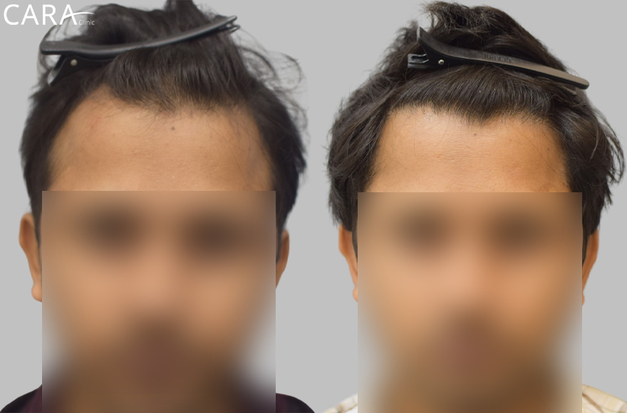 Farhan’s Natural Hairline Restoration: A Perfect Transformation