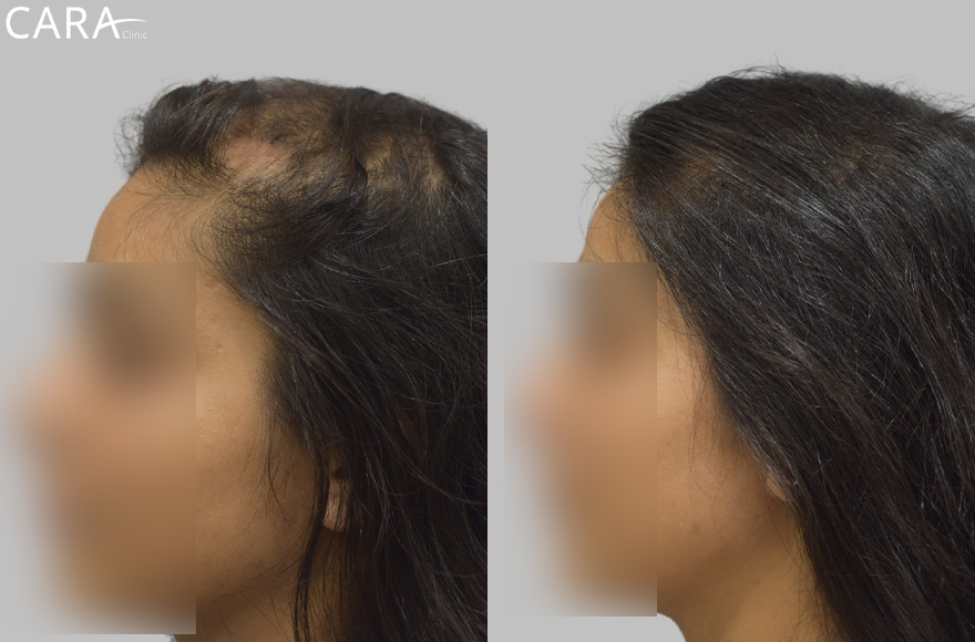 Banner showcasing the transformation of female hair loss treatment at Cara Clinic, featuring a before image with thinning hair and an after image with restored volume and density.