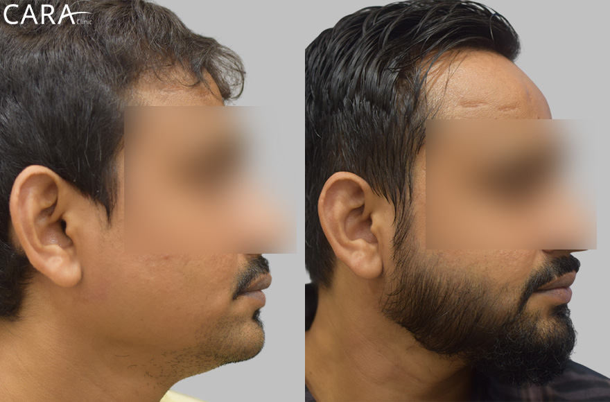 This is the banner image for Beard Hair Transplant treatment, featuring a man with a fuller and well-shaped beard