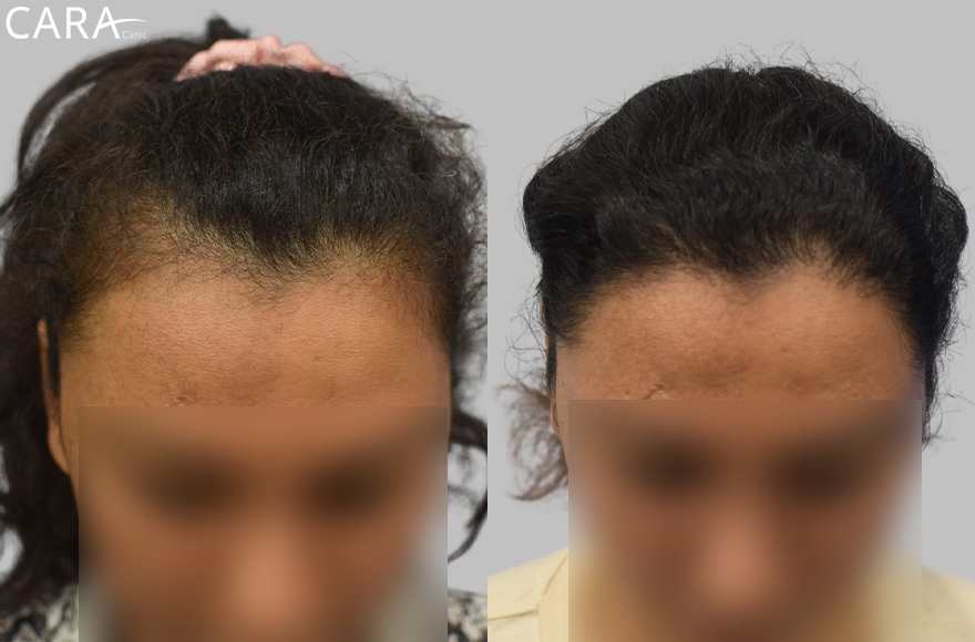 Before and after banner image of a female hair transplant showing significant improvement from thinning hair to a fuller, natural-looking hairline.