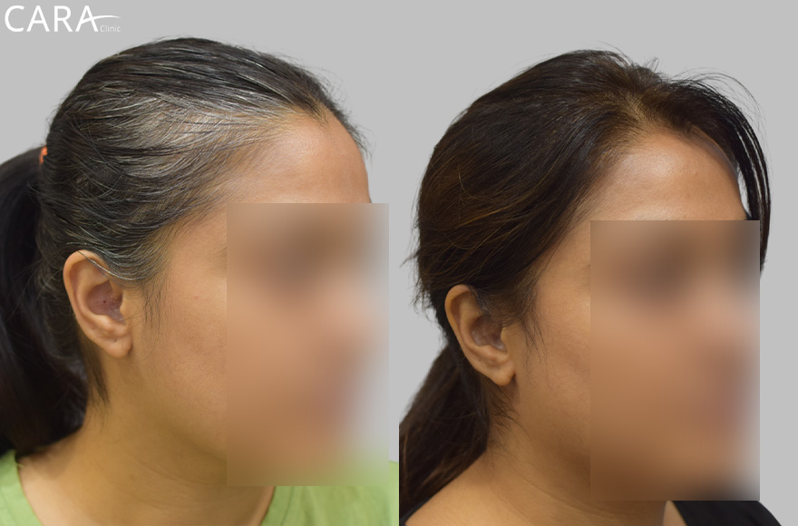 before and after image of female hairloss treatment image