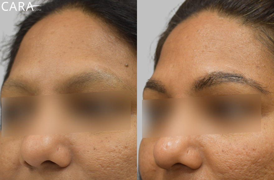 Banner showcasing the results of an eyebrow transplant at Cara Clinic, featuring a before image with sparse eyebrows and an after image with fuller, natural-looking brows.