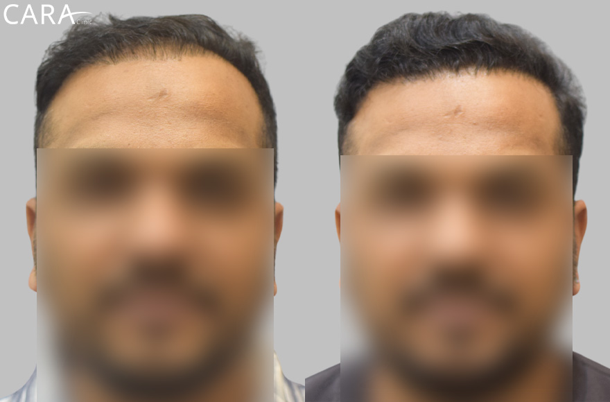 repair hair transplant image zain