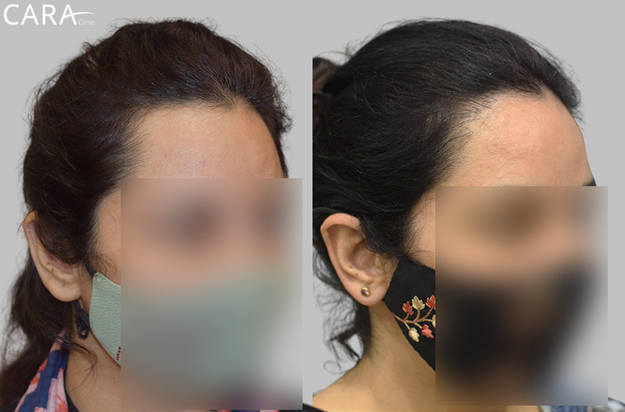 Before and after banner image of a female hair transplant showing significant improvement from thinning hair to a fuller, natural-looking hairline.