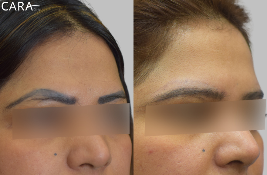 This is the banner image for Eyebrow Transplant treatment, highlighting full and naturally-shaped eyebrows