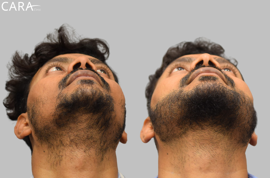 This is the banner image for Beard Hair Transplant treatment, featuring a man with a fuller and well-shaped beard