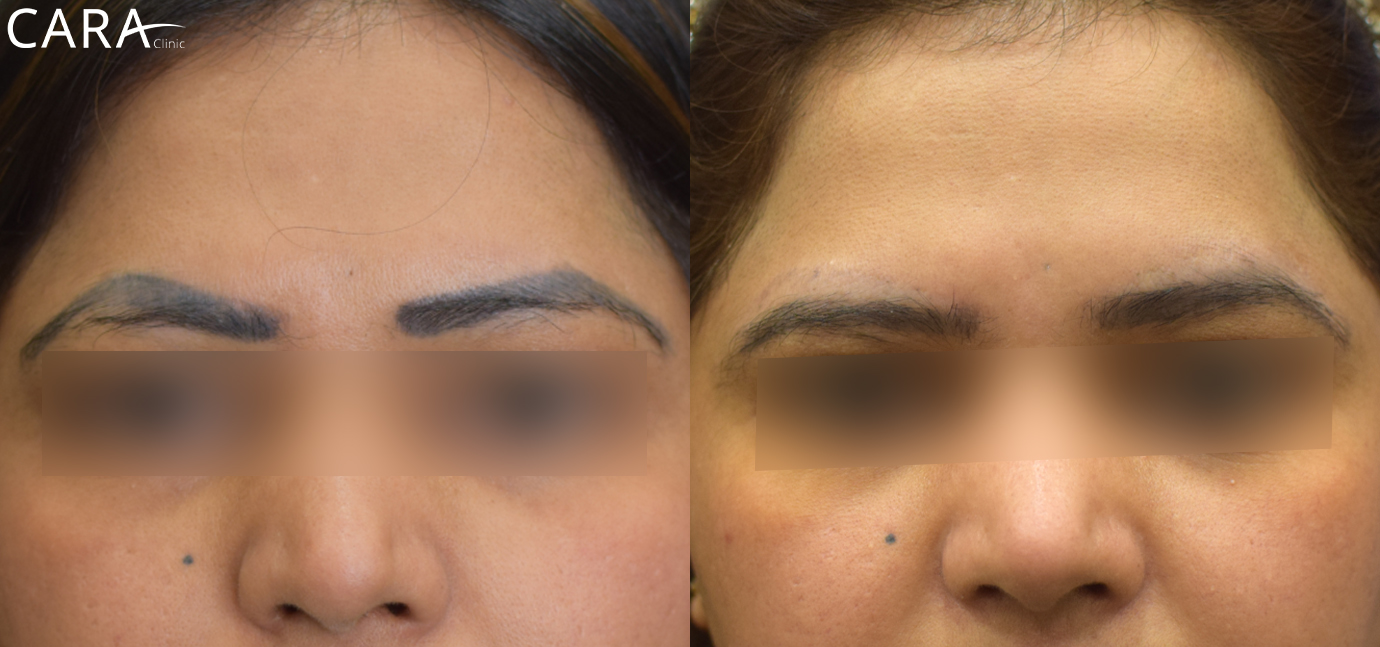 This is the banner image for Eyebrow Transplant treatment, highlighting full and naturally-shaped eyebrows