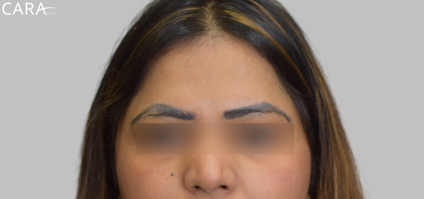 This is the banner image for Eyebrow Transplant treatment, highlighting full and naturally-shaped eyebrows