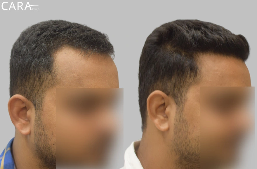 This is the banner image for Hairline Transplant treatment, showing a natural-looking restored hairline