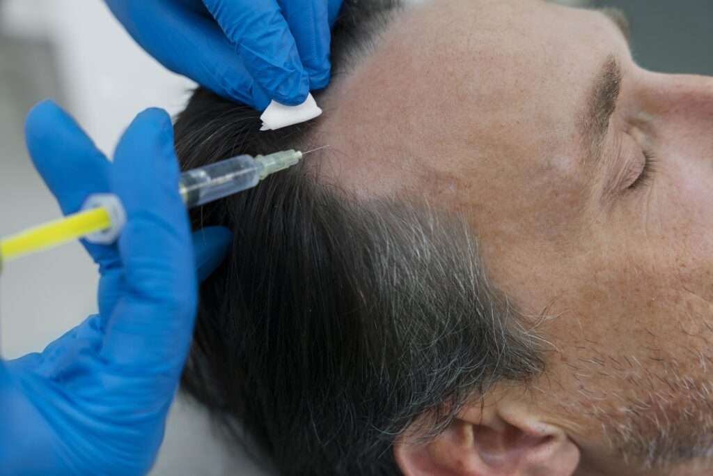 Why is Trichometric Sapphire FUE Hair Transplant Preferred?