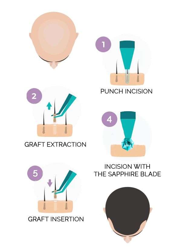 Sapphire-FUE-Hair-Transplant