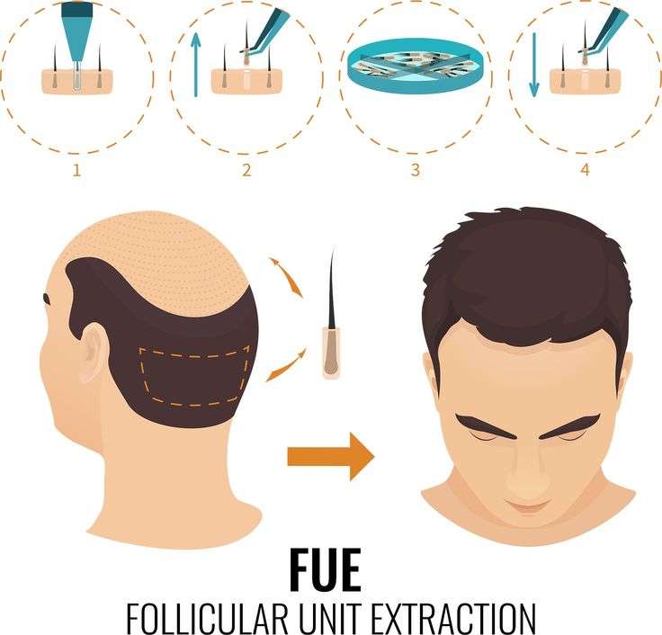 Understanding-FUE-Hair-Transplant
