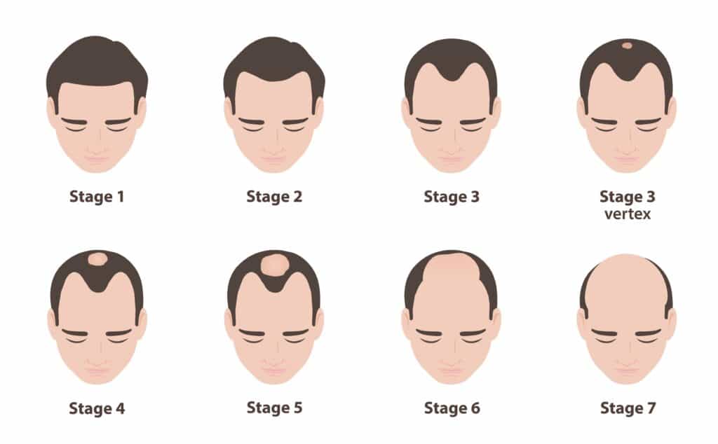 7 stages of Male Pattern Baldness