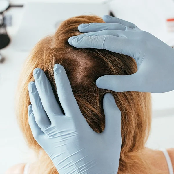 Here you can see a doctor is analysing hair loss of a patient.